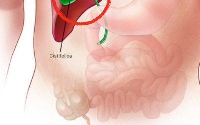 Cosa succede al corpo dopo la rimozione della cistifellea? 3 patologie che possono insorgere: se possibile, evitate l’intervento chirurgico.