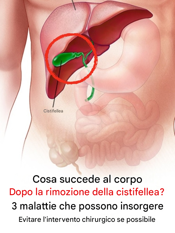 Cosa succede al corpo dopo la rimozione della cistifellea? 3 patologie che possono insorgere: se possibile, evitate l’intervento chirurgico.