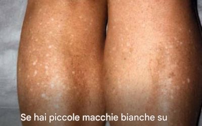 Perché mi compaiono macchie bianche sulla pelle d’estate e come posso trattarle? Risponde un dermatologo.