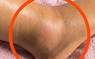 Se noti che le tue gambe sono gonfie, questo è un segno di cancro…