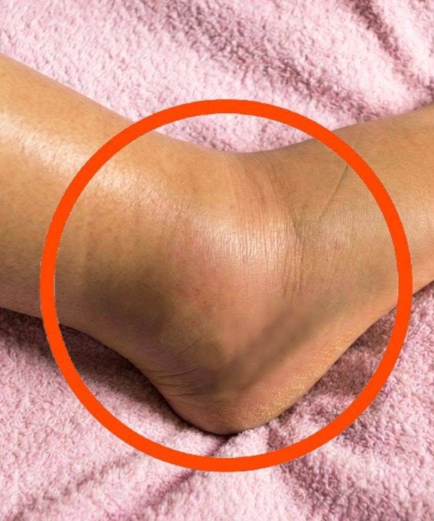 Se noti che le tue gambe sono gonfie, questo è un segno di cancro…